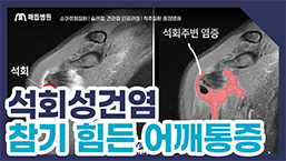 석회성건염 영상 썸네일